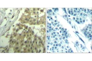 Immunohistochemical analysis of paraffin-embedded human breast carcinoma tissue using cdc2 (Ab-19) Antibody (E021529). (CDK1 抗体)