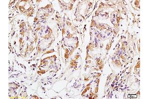 Formalin-fixed and paraffin embedded human colon carcinoma labeled with Anti GM130 Polyclonal Antibody, Unconjugated (ABIN872349) at 1:200 followed by conjugation to the secondary antibody and DAB staining (Golgin A2 (GOLGA2) (AA 851-1002) 抗体)