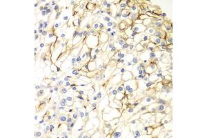 Immunohistochemistry of paraffin-embedded human kidney cancer using VANGL2 antibody (ABIN5975655) at dilution of 1/100 (40x lens). (VANGL2 抗体)