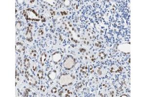 ABIN6267500 at 1/100 staining human Kidney carcinoma tissue sections by IHC-P. (BRCA1 抗体  (pSer1524))