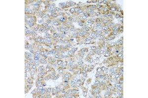 Immunohistochemistry of paraffin-embedded human liver cancer using NDUFA2 antibody (ABIN5974497) at dilution of 1/100 (40x lens). (NDUFA2 抗体)