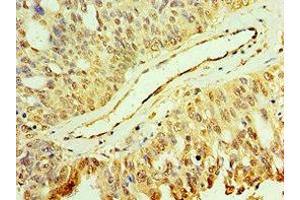 Immunohistochemistry of paraffin-embedded human endometrial cancer using ABIN7150705 at dilution of 1:100 (MAP2K3 抗体  (AA 1-170))