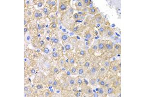 Immunohistochemistry of paraffin-embedded human liver cancer using CRK antibody (ABIN5975327) at dilution of 1/200 (40x lens). (Crk 抗体)
