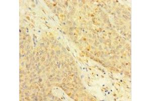 Immunohistochemistry of paraffin-embedded human ovarian cancer using ABIN7172118 at dilution of 1:100 (Thymidine Phosphorylase 抗体  (AA 13-254))
