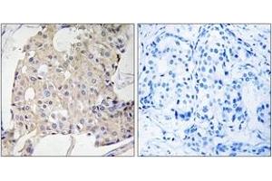 Immunohistochemistry analysis of paraffin-embedded human breast carcinoma tissue, using NDRG3 Antibody. (NDRG3 抗体  (AA 206-255))