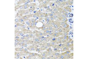 Immunohistochemistry of paraffin-embedded human liver injury using DFNA5 antibody (ABIN5975144) at dilution of 1/100 (40x lens). (DFNA5 抗体)