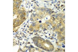 Immunohistochemistry of paraffin-embedded human gastric cancer using DPP3 antibody. (DPP3 抗体  (AA 1-280))