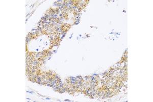 Immunohistochemistry of paraffin-embedded human colon carcinoma using ZAK antibody (ABIN6133445, ABIN6150360, ABIN6150361 and ABIN6223229) at dilution of 1:100 (40x lens). (ZAK 抗体  (AA 1-330))