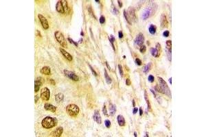 Immunohistochemical analysis of Histone H4 (AcK5) staining in human lung cancer formalin fixed paraffin embedded tissue section. (Histone H4 抗体  (acLys5, N-Term))