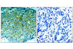 Immunohistochemical analysis of paraffin-embedded human breast carcinoma tissue, using PAK1 (Ab-212) antibody (E021160). (PAK1 抗体)