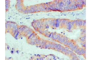 Immunohistochemical of paraffin-embedded Human Colon cancer tissue using ABIN7145293 at dilution of 1:200 (BCL2L1 抗体)