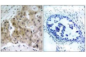 Immunohistochemical analysis of paraffin-embedded human breast carcinoma tissue, using V (VEGFR2/CD309 抗体  (pTyr1175))