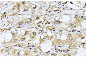 Immunohistochemistry of paraffin-embedded Human liver cancer using PSMA7 Polyclonal Antibody at dilution of 1:100 (40x lens). (PSMA7 抗体)