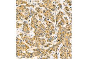 Immunohistochemistry of paraffin embedded human colon cancer using BPTF (ABIN7073234) at dilution of 1:500 (400x lens) (BPTF 抗体)