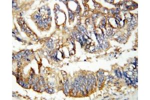 IHC-P: Calretinin antibody testing of human rectal cancer tissue (Calretinin 抗体  (N-Term))