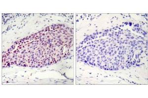 Immunohistochemical analysis of paraffin-embedded human breast carcinoma tissue using ATF-2 (Ab-112 or 94) antibody (E021033). (ATF2 抗体)