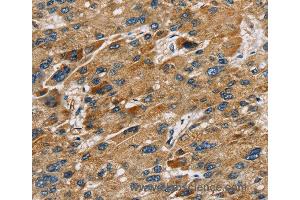 Immunohistochemistry of Human liver cancer using SULT1B1 Polyclonal Antibody at dilution of 1:30 (SULT1B1 抗体)