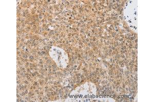Immunohistochemistry of Human lung cancer using SERPINE2 Polyclonal Antibody at dilution of 1:20 (SERPINE2 抗体)
