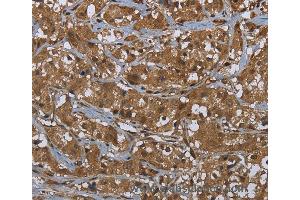 Immunohistochemistry of Human cervical cancer using GCK Polyclonal Antibody at dilution of 1:60 (GCK 抗体)
