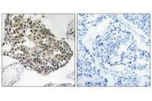 Immunohistochemistry analysis of paraffin-embedded human breast carcinoma tissue using RPS25 antibody. (RPS25 抗体)