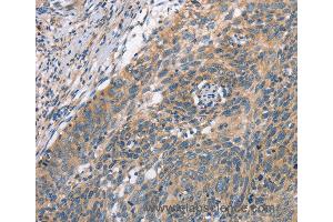 Immunohistochemistry of Human cervical cancer using PLEKHO1 Polyclonal Antibody at dilution of 1:70 (PLEKHO1 抗体)