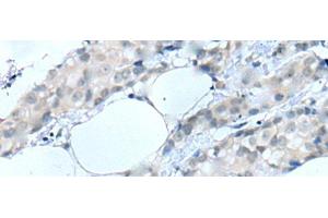 Immunohistochemistry of paraffin-embedded Human breast cancer tissue using MOG Polyclonal Antibody at dilution of 1:25(x200) (MOG 抗体)