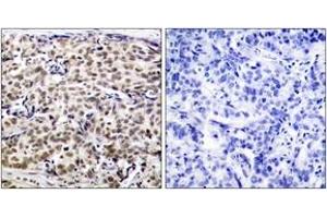 Immunohistochemistry analysis of paraffin-embedded human breast carcinoma tissue, using CREB (Ab-129) Antibody. (CREB1 抗体  (AA 96-145))