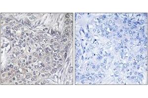 Immunohistochemistry analysis of paraffin-embedded human breast carcinoma, using 4E-BP1 (Phospho-Thr45) Antibody. (eIF4EBP1 抗体  (pThr46))