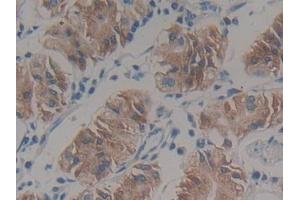 IHC-P analysis of Human Stomach cancer Tissue, with DAB staining. (HSD17B12 抗体  (AA 1-312))