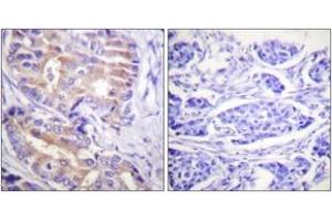 Immunohistochemistry analysis of paraffin-embedded human breast carcinoma tissue, using p70 S6 Kinase (Ab-389) Antibody. (RPS6KB1 抗体  (AA 355-404))