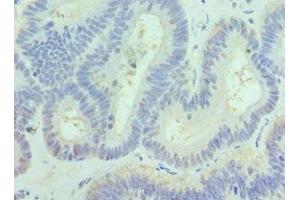 Immunohistochemistry of paraffin-embedded human colon cancer using ABIN7169126 at dilution of 1:100 (PAK1 抗体  (AA 1-240))