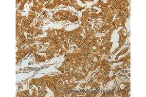 Immunohistochemistry of Human lung cancer using MC4R Polyclonal Antibody at dilution of 1:50 (MC4R 抗体)