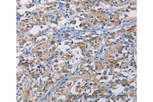 Immunohistochemistry of Human liver cancer using RICTOR Polyclonal Antibody at dilution of 1:50 (RICTOR 抗体)