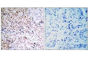 Immunohistochemical analysis of paraffin-embedded human breast carcinoma tissue, using Rb (phospho- Ser795) antibody (E011130). (Retinoblastoma 1 抗体  (pSer795))
