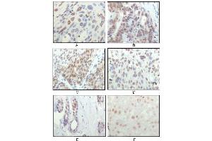 Immunohistochemical analysis of paraffin-embedded human esophageal squamous cell carcinoma (A), colon adenocarcinoma (B), liver carcinoma (C), skin carcinoma (D), breast ductal tumor (E) and brain tumor (F), showing nuclear localization using RSK1 mouse mAb with DAB staining. (RPS6KA1 抗体)