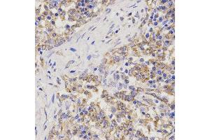 Immunohistochemistry of paraffin-embedded human lung cancer using TNFRSF1B antibody at dilution of 1:200 (x400 lens). (TNFRSF1B 抗体)